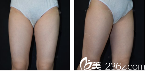 广州韩妃吸脂案例术前照片 广州韩妃吸脂案例术前照片