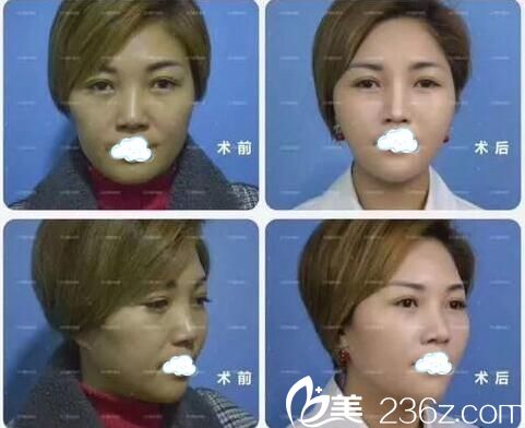 达州双均线雕提升术后正面侧面效果 达州双均线雕提升术后正面侧面效果