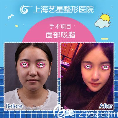 我在上海艺星做面部吸脂后的样子