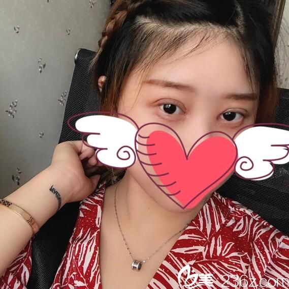 切开双眼皮开眼角术后半个月恢复情况 切开双眼皮开眼角术后半个月恢复情况