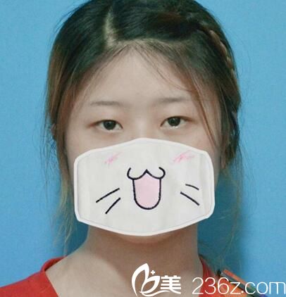 在达州双均做双眼皮前的照片 在达州双均做双眼皮前的照片