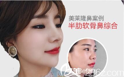 上海美莱医疗美容医院  半肋软骨鼻综合真人案例