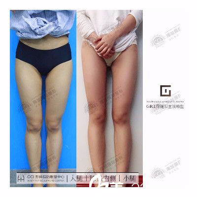 北京南加张清峰医生大腿吸脂前后对比图