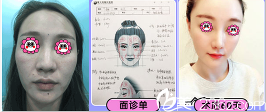 北京樱桃自体脂肪面部填充优惠中！单部位价格1280 元起