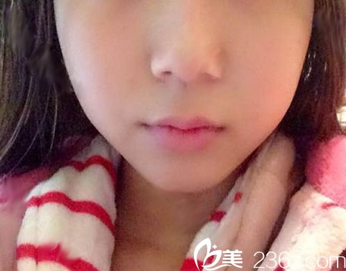 我在南宁华美打瘦脸