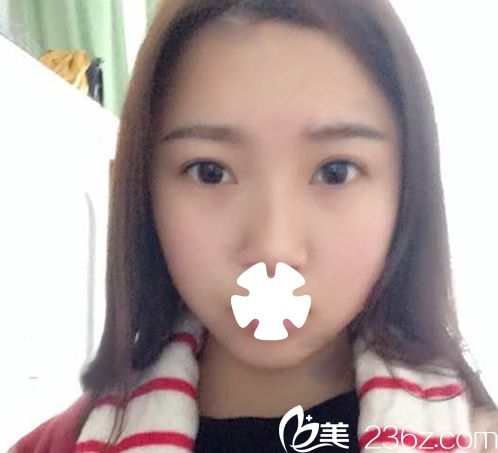 我在华美整形打瘦脸术后第10天照片