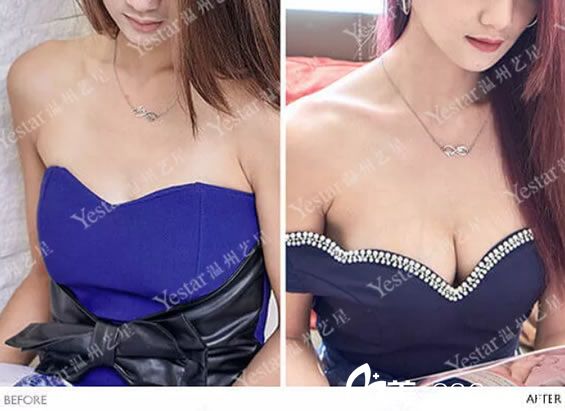 做完假体隆胸穿礼服<span style= 做完假体隆胸穿礼服<span style=