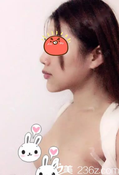 做完曼托假体隆胸5天恢复照