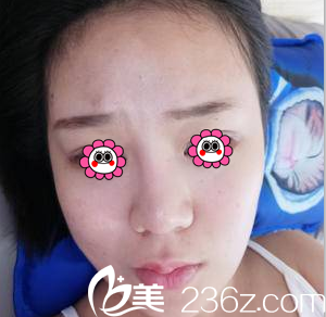 在北京艺星做假体隆鼻+耳软骨垫鼻尖前样子 在北京艺星做假体隆鼻+耳软骨垫鼻尖前样子