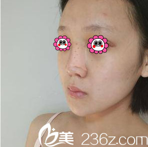 连凯峰医生给我做假体隆鼻+耳软骨垫鼻尖第3天样子 连凯峰医生给我做假体隆鼻+耳软骨垫鼻尖第3天样子