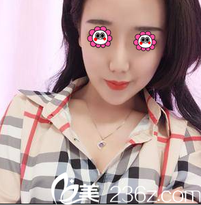 在北京艺星做假体隆鼻+耳软骨垫鼻尖第15天效果 在北京艺星做假体隆鼻+耳软骨垫鼻尖第15天效果