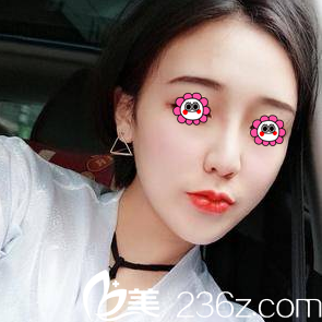 北京艺星连凯峰假体隆鼻+耳软骨垫鼻尖案例 北京艺星连凯峰假体隆鼻+耳软骨垫鼻尖案例