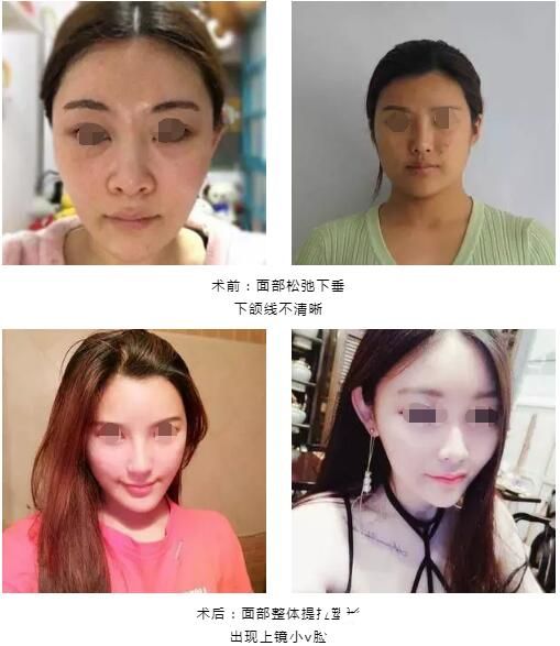 李雄艳分享自体脂肪填充抗衰案例对比 李雄艳分享自体脂肪填充抗衰案例对比