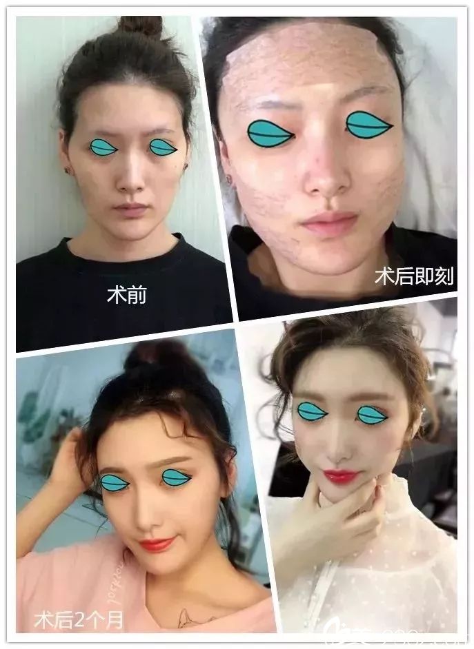 自体脂肪or线雕?无锡施尔美医生用真人前后对比照告诉你抗衰到底该选择哪一种