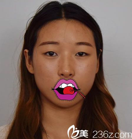 还没在嘉兴禾美做双眼皮前的我 还没在嘉兴禾美做双眼皮前的我