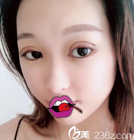 嘉兴禾美刚做完双眼皮的照片 嘉兴禾美刚做完双眼皮的照片