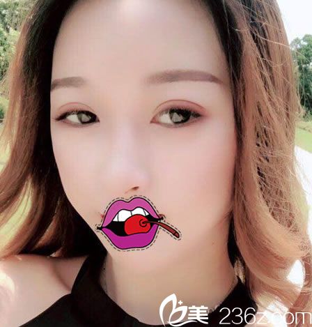 嘉兴禾美整形伞光双眼皮案例 嘉兴禾美整形伞光双眼皮案例