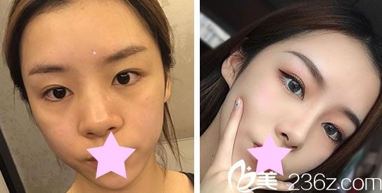 圣宜美容鼻综合+肋软骨隆鼻效果对比图 圣宜美容鼻综合+肋软骨隆鼻效果对比图