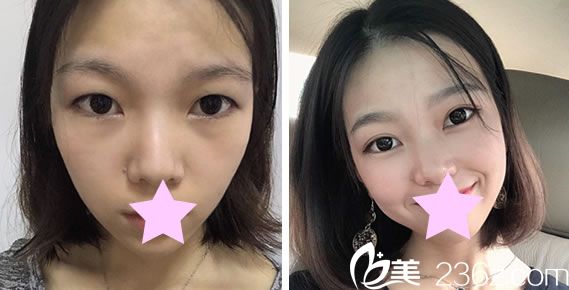 台北圣宜眼综合+全切双眼皮效果对比图 台北圣宜眼综合+全切双眼皮效果对比图