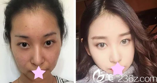 台北圣宜美容整形面部线雕提升真人案例 台北圣宜美容整形面部线雕提升真人案例