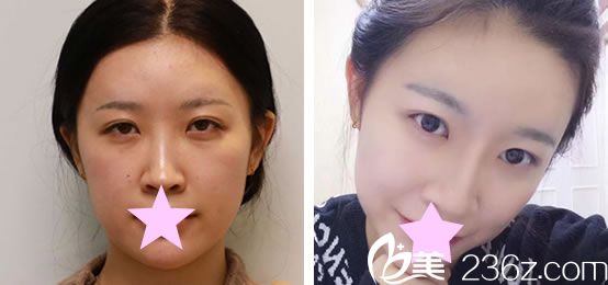 中国台湾杜蕾莉王中原做鼻综合+耳软骨隆鼻效果对比图
