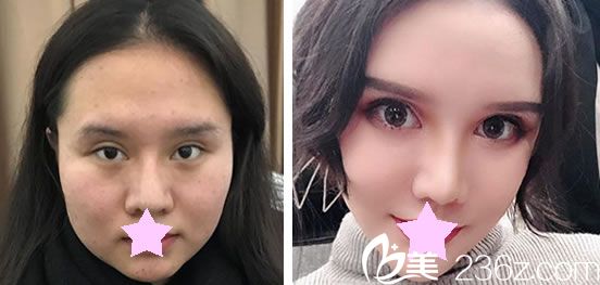 卢荣祥做假体隆鼻+下頜角整形效果对比图 卢荣祥做假体隆鼻+下頜角整形效果对比图