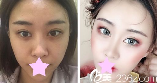 卢荣祥做面部脂肪填充效果对比图 卢荣祥做面部脂肪填充效果对比图