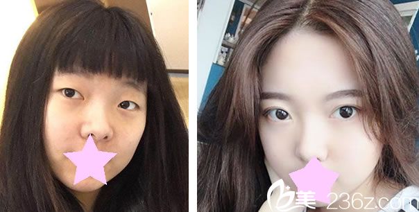 台北楷钧时尚美容诊所卢荣祥做全切双眼皮效果对比图 台北楷钧时尚美容诊所卢荣祥做全切双眼皮效果对比图