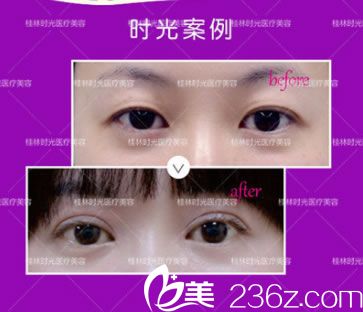 桂林时光整形全切双眼皮术前术后对比图