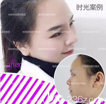 桂林时光美莱整形鼻综合隆鼻案例 桂林时光美莱整形鼻综合隆鼻案例