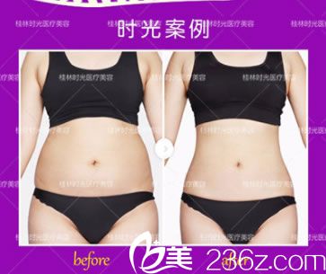 桂林时光整形腰腹部环形吸脂塑形案例效果 桂林时光整形腰腹部环形吸脂塑形案例效果