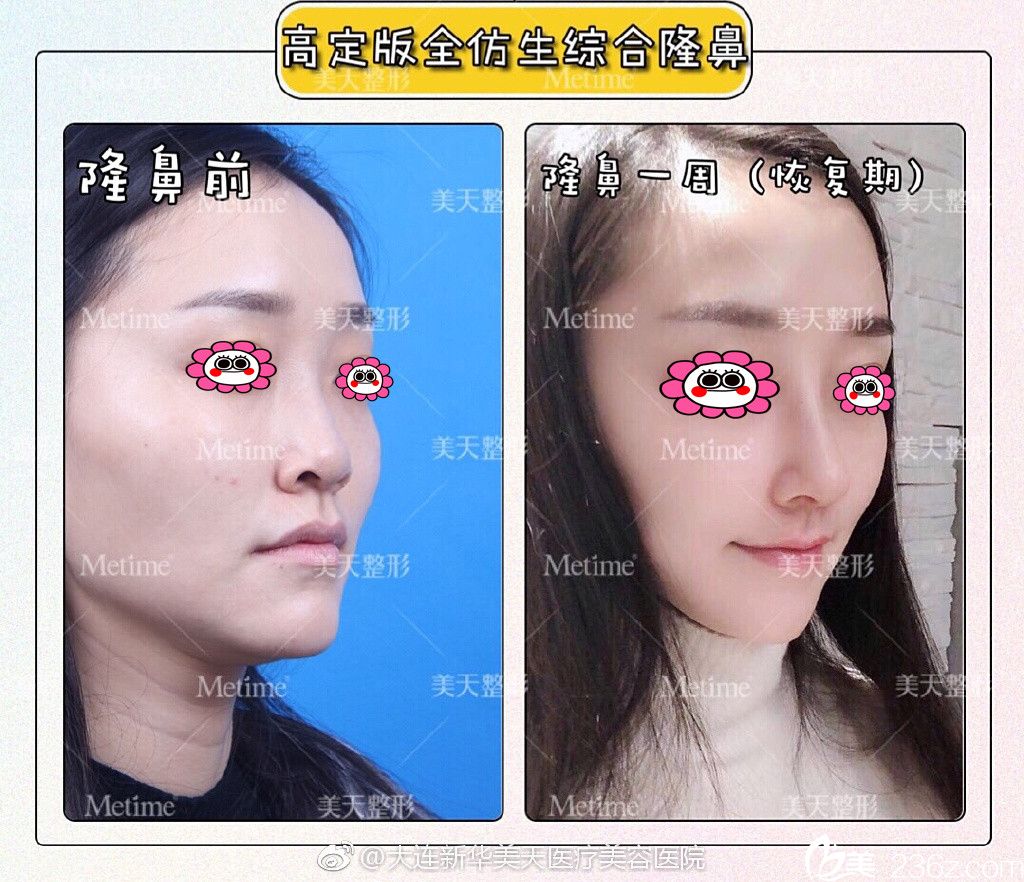 大连新华美天隆鼻前后对比图 大连新华美天隆鼻前后对比图