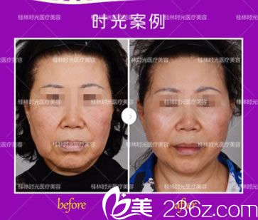 时光整形全脸4D线雕提升前后对比图 时光整形全脸4D线雕提升前后对比图