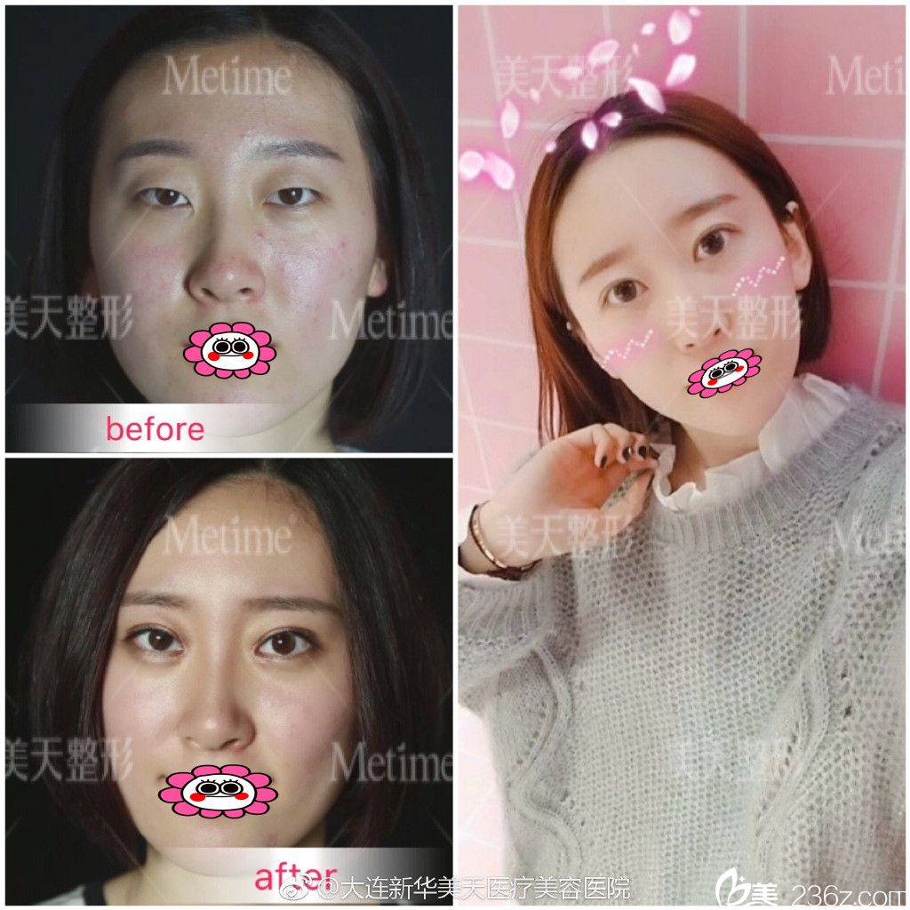 大连新华张井忠双眼皮效果图 大连新华张井忠双眼皮效果图