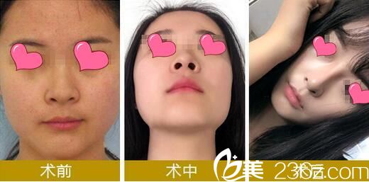 华美悦美整形医院隆鼻前后对比