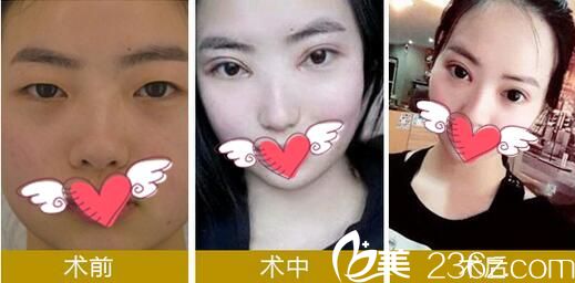 华美悦美整形双眼皮手术案例