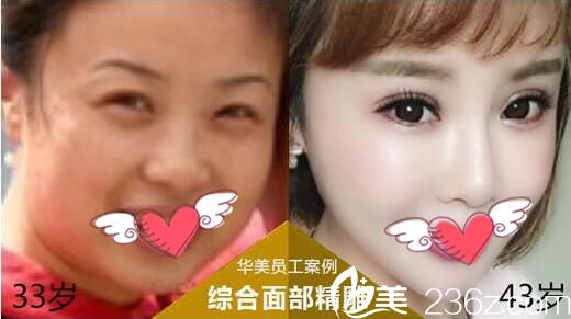 面部精雕手术前后对比照片