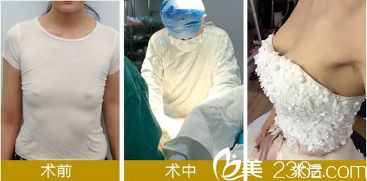 假体丰胸手术前后对比效果