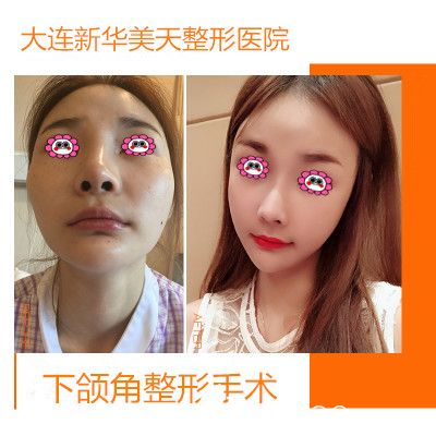 大连新华美天整形下颌骨削骨变化图 大连新华美天整形下颌骨削骨变化图