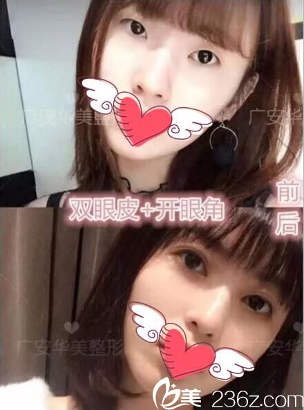 双眼皮开眼角手术对比效果 双眼皮开眼角手术对比效果
