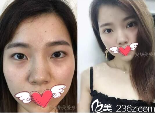 <!--<i data=20240703-sp></i>-->华美无痕双眼皮术前术后对比照片 <!--<i data=20240703-sp></i>-->华美无痕双眼皮术前术后对比照片