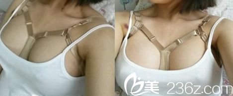 我在桂林时光整形做假体隆胸术后第3天照片