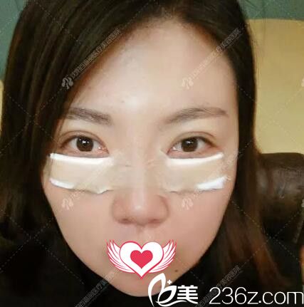 祛眼袋术后即刻效果