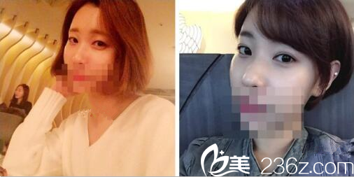 韩国迪美THE M做双眼皮挺好的 韩国迪美THE M做双眼皮挺好的