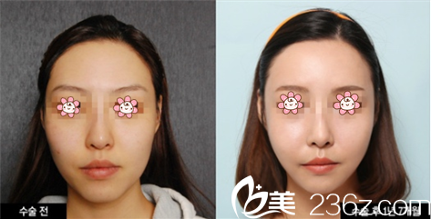 韩国迪美面部埋线提升真人实例图好看 韩国迪美面部埋线提升真人实例图好看