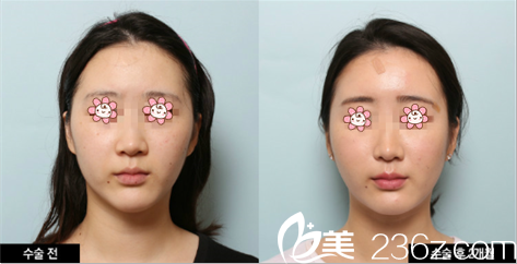 韩国迪美自体脂肪面部填充改善自然 韩国迪美自体脂肪面部填充改善自然