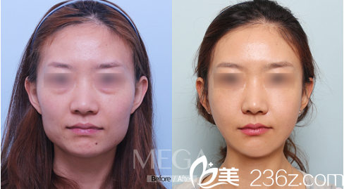 韩国迪美做下颌角手术好 韩国迪美做下颌角手术好