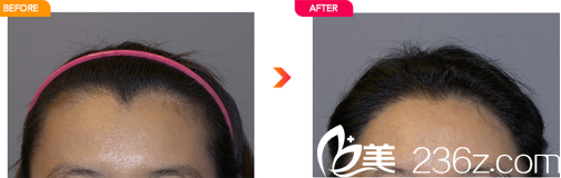 韩国迪美发际线种植实例图 韩国迪美发际线种植实例图