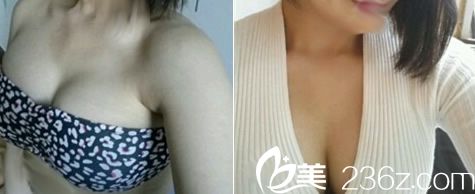 透露我在桂林时光整形做曼托275cc假体隆胸62天恢复实况，胸部从A直接到C