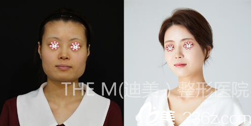 韩国迪美整形改脸型技术好不好